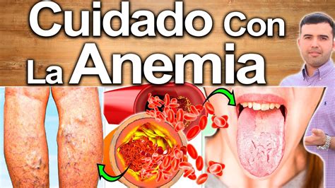 como saber si tengo anemia - como tirar chulé do pé